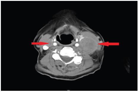 An Unsusual Extrapulmonary Neuroendocrine Tumour Of Head And Neck
