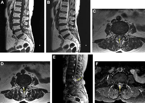 Hypertrophied Ligamentum Flavum Mri The Radiology Assistant Lumbar Disc Herniation In 2020