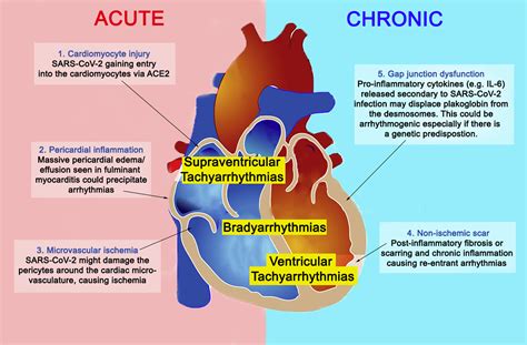 Ropean society of cardiology working group on myocardial and pericar Recognizing COVID-19-related myocarditis: The possible ...