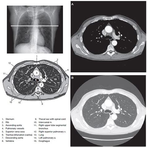 How To Read A Chest Ct Scan