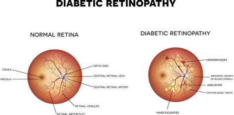 Hypertensive Retinopathy Vs Diabetic Retinopathy