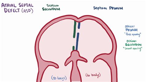 Atrial Septal Defect Asd Repair Causes Types Symptoms And Pathology