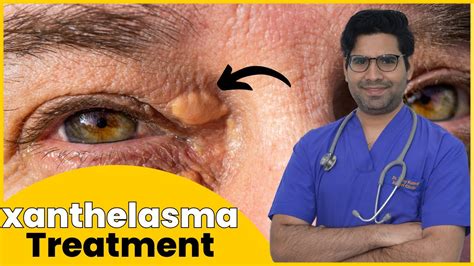 Xanthelasma Treatment Yellow Bump On Or Near Your Eyelid Skin