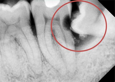 Everything You Need To Know About The Wisdom Teeth For Better Oral