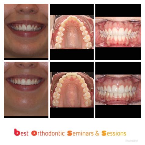 Amazing 6 Month Smile Transformation Best Orthodontic Seminars Sessions