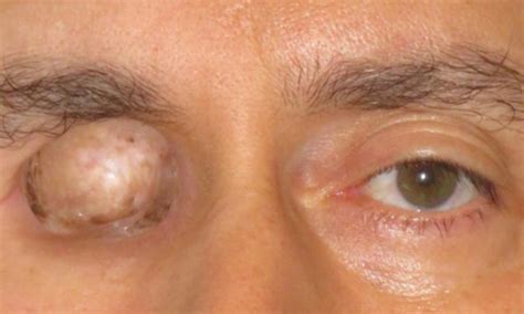 Carcinoma Squamoso Del Fondo Oculare Dalpasso Protesi Oculari My Xxx