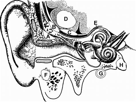 Imaging Of Complications Of Acute Mastoiditis In Children Radiographics