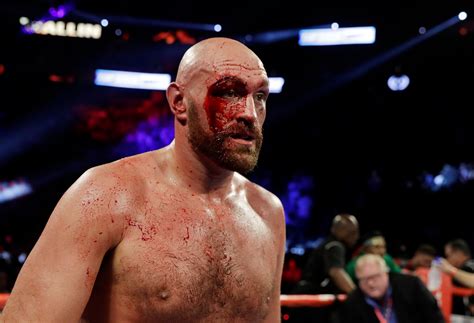 Tyson Fury Had Web Mesh Inserted In Horror Gash That Required Stitches As Cut Man Reveals All