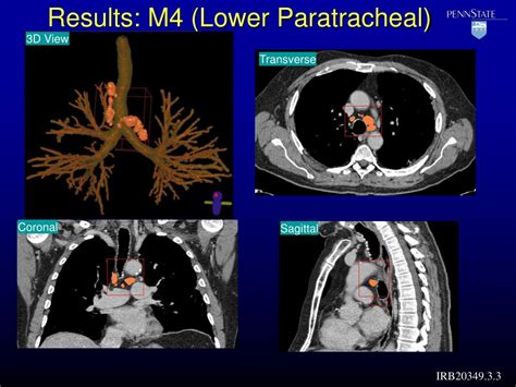 Ppt Extraction And Visualization Of The Central Chest Lymph Node