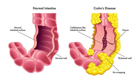 Crohn S Disease Ulcerative Colitis Siena College Of Health