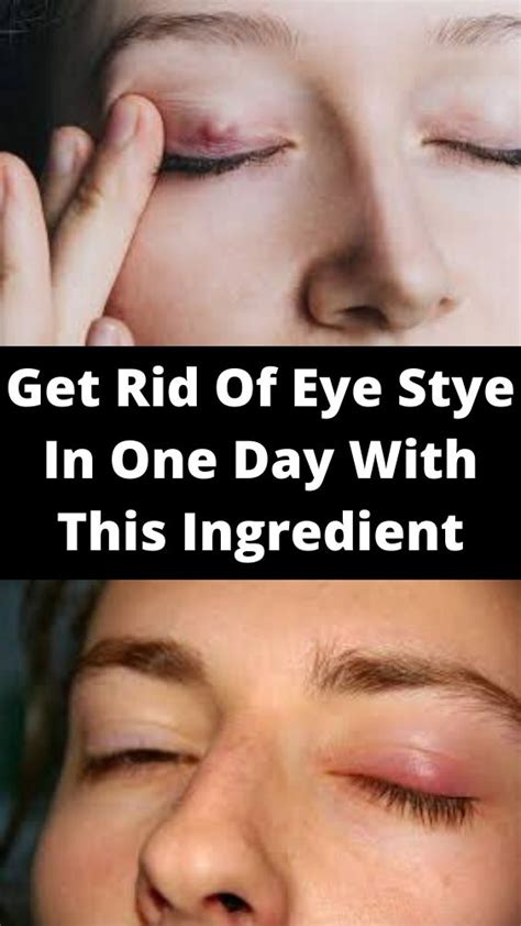 How To Get Rid Of Eye Pimple Eye Pimple Pimples Pimple On Eyelid