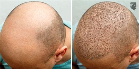 Busting The Myths That Hair Transplant Causes Cancer Ahs India