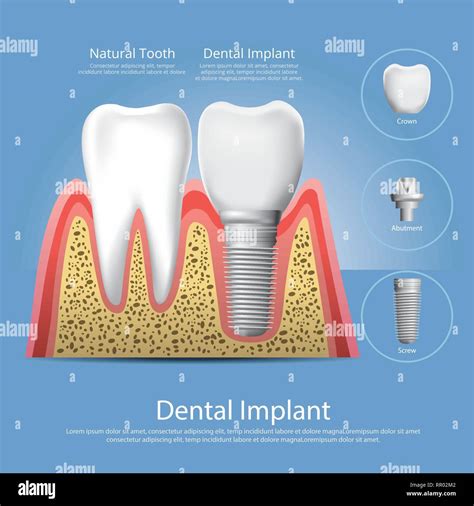 Los Dientes Humanos Y Implante Dental Ilustración Vectorial Imagen