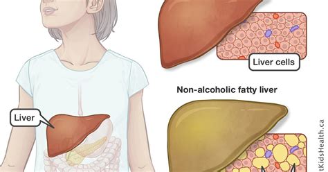 Non Alcoholic Fatty Liver Disease Nafld And Diabetes