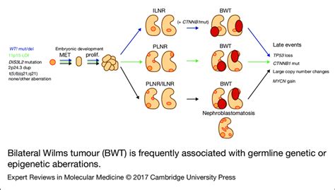 Bilateral Wilms Tumour Bwt Is Frequently Associated With Germline