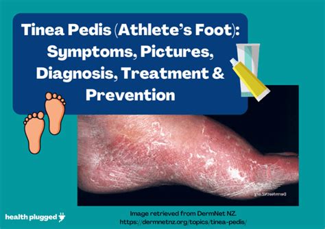 Tinea Pedis Symptoms Pictures Diagnosis Treatment And Prevention