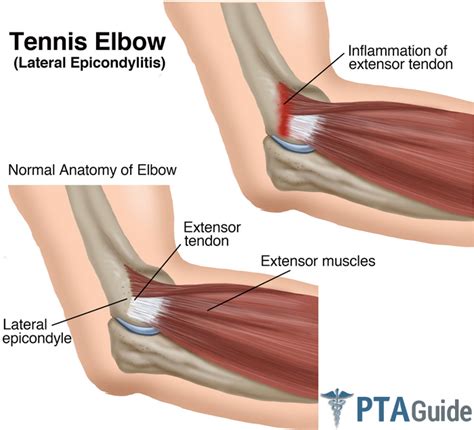 After your recovery, your doctor or physical therapist can instruct you in how these exercises can be continued as a maintenance program for lifelong protection and. Tennis Elbow & Exercises for Therapy: The Complete ...