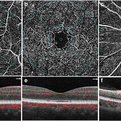 Macula And Optic Nerve Head Onh Retinal Optical Coherence Tomography