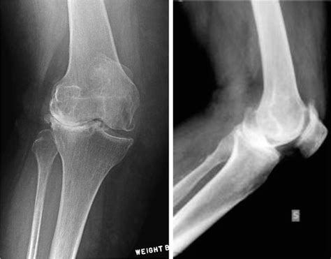 Valgus Deformity Correction In Total Knee Replacement An Overview