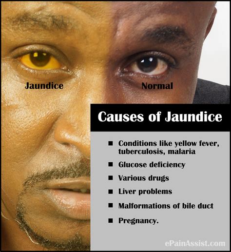 Home Remedies For Jaundice In Adults