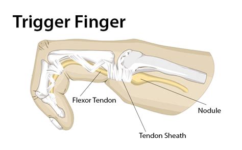 Trigger Finger Pt Health