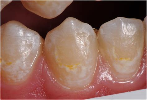 Treatment Of “white Spot Lesions” After Removal Of Fixed Orthodontic