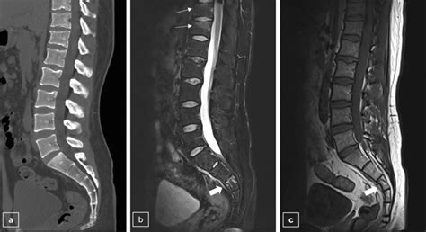 Patients With Recent Compression Fractures At The Vertebral Bodies Of