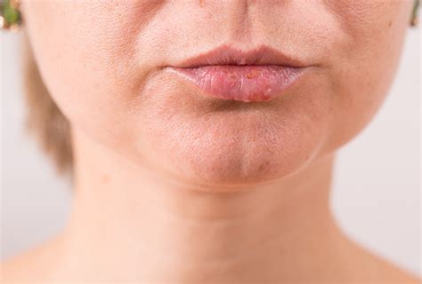 Fordyce White Spots On Lips Pictures