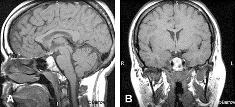 Imaging Of The Pituitary Gland Barrow