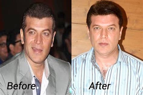 Famous And Bollywood Celebrity Hair Transplants