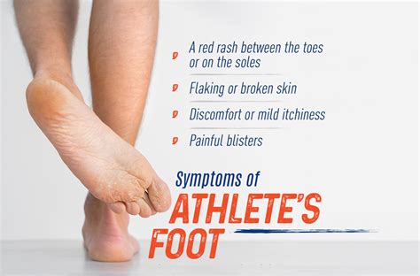 Symptoms Of Athletes Foot