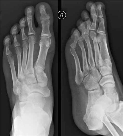 Figure 4 From Diagnostic Imaging Of Psoriatic Arthritis Part I