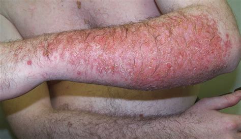 Allergic Contact Dermatitis Causes Symptoms Diagnosis Treatment And Prognosis