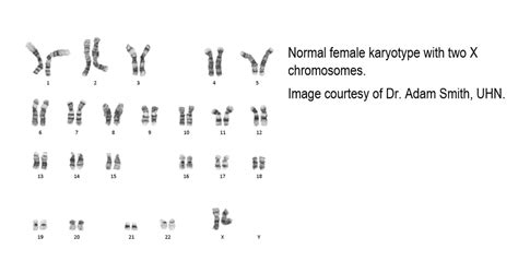 Karyotype Pathology Dictionary Mypathologyreportca