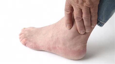 Gout Symptoms Foot Picture Pictures Photos