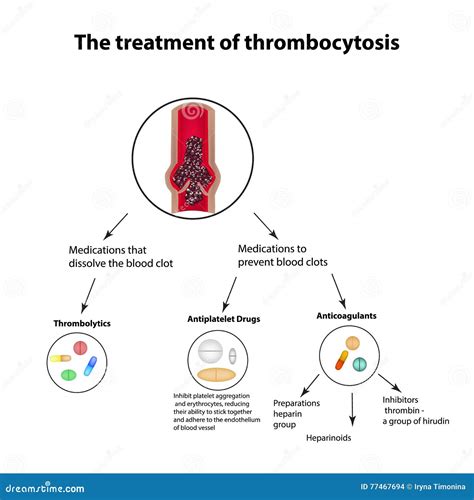 The Treatment Of Thrombocytosis Embolism Infographics Vector