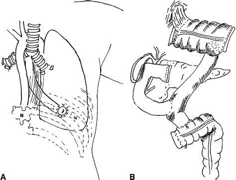 Thoracic Esophagostomy A Novel Surgical Approach For Preservation Of