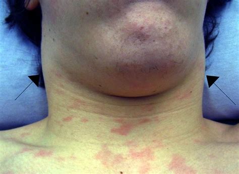 Eine schmerzhafte, seitliche schwellung am hals beruht oft auf einer unspezifischen lymphknotenentzündung, die von einer bakteriellen oder viralen infektion im kopfbereich herrührt (z.b. Mononukleose: Prüfungsfragen für Heilberufe