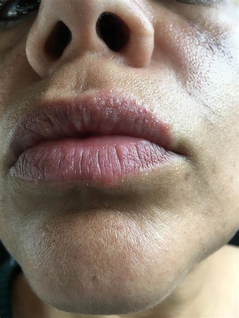 Solodyn 7 Days Now Lips Blistering Prescription Acne Medications