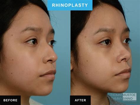 Rhinoplasty Before And After Photo Showcase See Real Solutions For 4