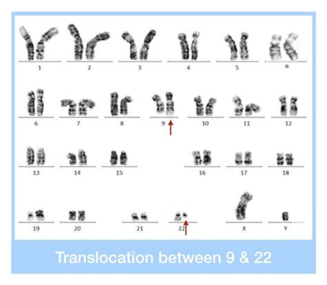 Philadelphia Chromosome Bcr Abl1 Gene Fusion And Chronic Myeloid Leukemia