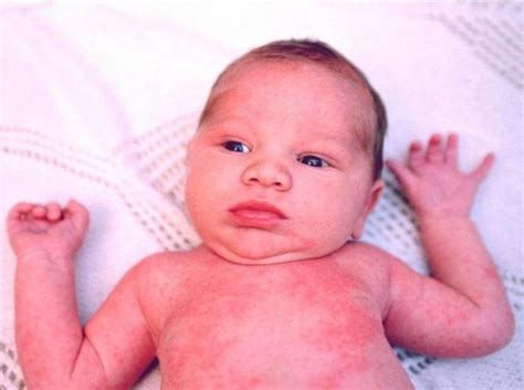 The toxin found in poison ivy, oak, and sumac causes an itchy, allergic rash with raised welts and blisters. baby rash identification pictures - Yahoo Image Search ...