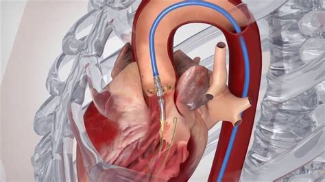 Factors Affecting Recovery From Heart Valve Surgery Heart Valves