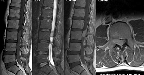 Roentgen Ray Reader Chordoma Drop Metastases
