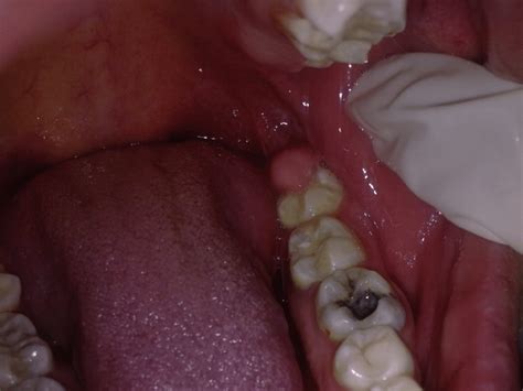 What Are The Crucial Things To Know Regarding Pericoronitis
