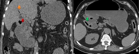 Abdominal Ct Scan Without Contrast Enhancement In Coronal And Axial
