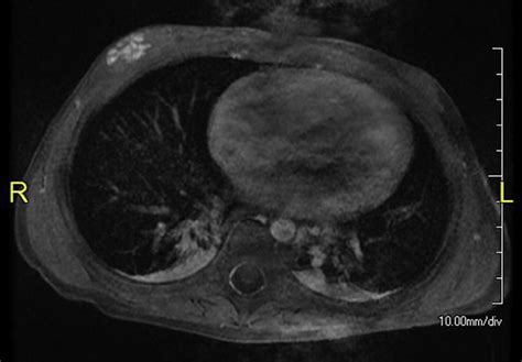 Axial Postcontrast T1 With Fat Suppression Demonstrating Heterogeneous