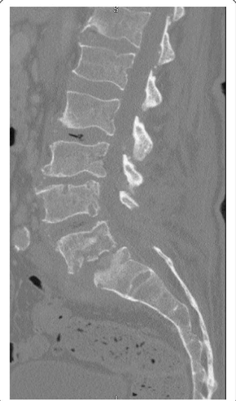 Lumbar Ct Sagittal Reconstruction Progression Of Osteomyelitis At L4