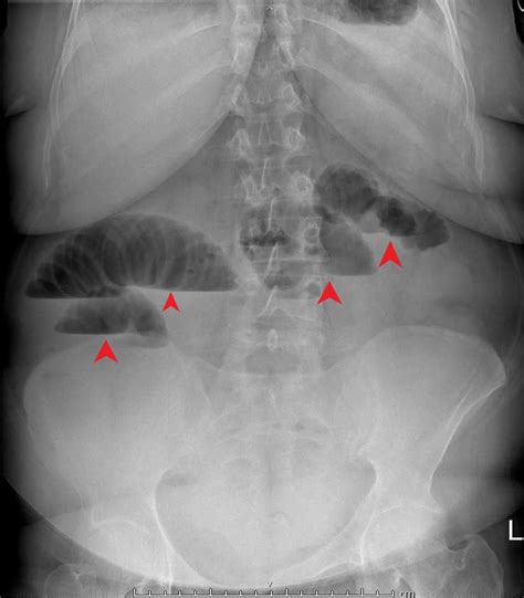 Cureus A Rare Presentation Of Small Bowel Obstruction Due To Obstructed Indirect Inguinal Hernia