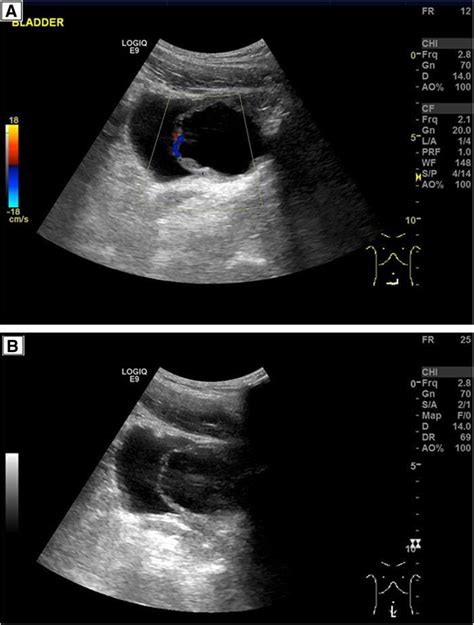 A B Abdominal Ultrasound Scan Showing The Cystic Lesion And